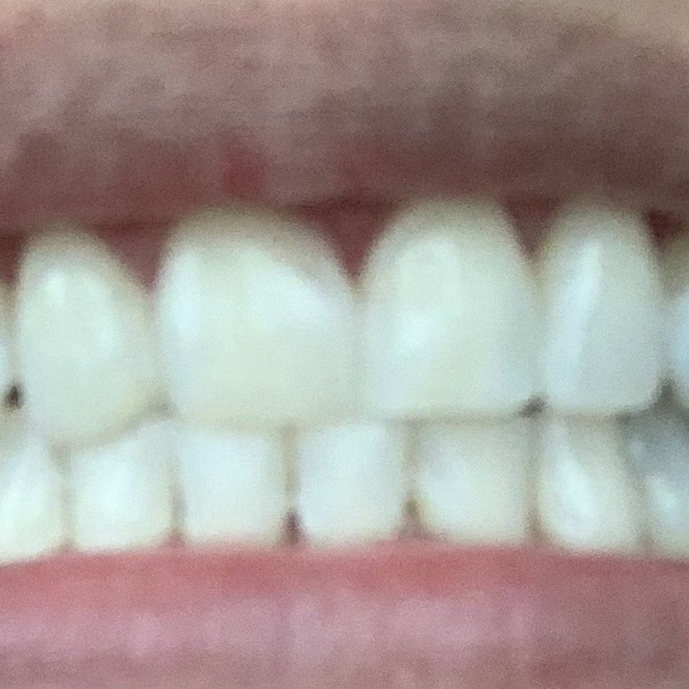 Illumination Teeth Whitening - Teeth Whitening Near Me - Diamond Bar , California