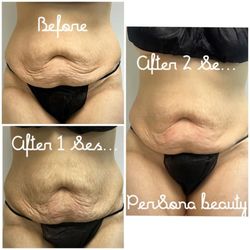 Persona Beauty - EMS & Fire massage results after 2 sessions