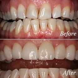 Cambridge Smiles - Improve your smile with porcelain veneers