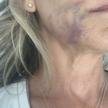 Skin Envy Austin- William Cannon Dr - 1 day post procedure - Medical Spas Near Me - Austin, Texas Skin Envy Austin- William Cannon Dr - 1 day post procedure - Medical Spas Near Me - Austin, Texas