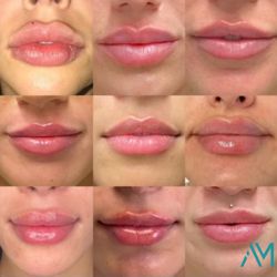 AuraMed Aesthetics - Lip filler