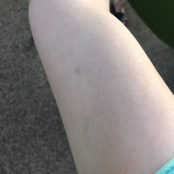 Irvine Spa - Bruising after acupressure massage I received from Joy. - Day Spas Near Me - Irvine, California Irvine Spa - Bruising after acupressure massage I received from Joy. - Day Spas Near Me - Irvine, California