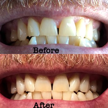 Annette Van Natta, DDS - Teeth cleaned and laser whitening. - General Dentistry Near Me - Irving, Texas Annette Van Natta, DDS - Teeth cleaned and laser whitening. - General Dentistry Near Me - Irving, Texas