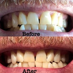 Annette Van Natta, DDS - Teeth cleaned and laser whitening.