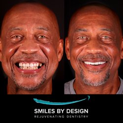 Smiles By Design - Rejuvenating Implant Dentistry
