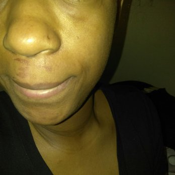 Happy Nails & Spa - Marks on my lip from waxing - Nail Salons Near Me - Chesapeake, Virginia Happy Nails & Spa - Marks on my lip from waxing - Nail Salons Near Me - Chesapeake, Virginia