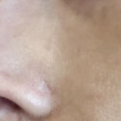 Revive Medical Botox and Laser - Atrophic scar 3 months later with foundation on (which I now feel I need to wear every time I leave the house)