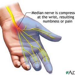Wint C Jeffrey, MD - Carpal tunnel and numbness in the thumb, index and middle fingers