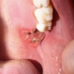 SoCal Surgical Arts - Again I'm no doctor I don't know if this is normal but it looks pretty awful and feels even worse
