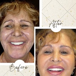 Cosmetistry by Dr P - Botox and fillers on a 60+ patient. She's refreshed