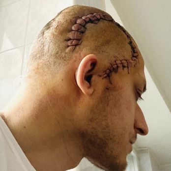 Pouya Lavian, MD - My brain surgery. - Neurologist Near Me - Encino, California Pouya Lavian, MD - My brain surgery. - Neurologist Near Me - Encino, California
