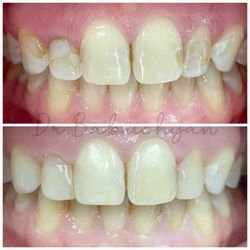 Valentina Babuchyan, DDS - Valley Dental Spa - Chairside dental bondings(replacement of old restorations); keeping natural shade of teeth and enhancing unique smile of this patient.