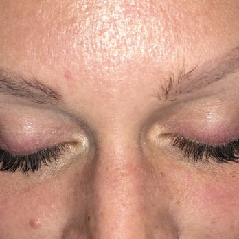 Blush Electrolysis & Skin Care - Before - Skin Care Near Me - Chicago, Illinois Blush Electrolysis & Skin Care - Before - Skin Care Near Me - Chicago, Illinois