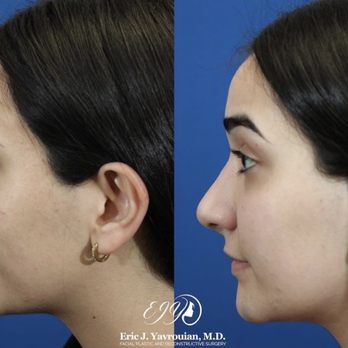 Eric Yavrouian, MD - Nose Job - Ear Nose & Throat Near Me - Glendale, California Eric Yavrouian, MD - Nose Job - Ear Nose & Throat Near Me - Glendale, California