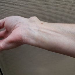 Ganglion cyst