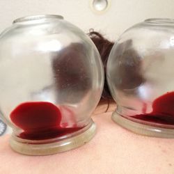 Boulder Body Balance Acupuncture & Massage - Has anyone told you about wet cupping? Check out our website to learn more on how you can detox fast!