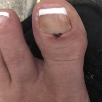 Glamour Nails - Chopped off my cuticle - Nail Salons Near Me - Hamburg, New York