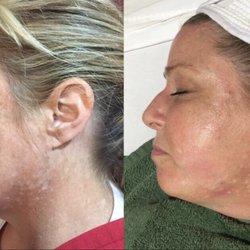 Flawless Skin - Triple transformation peel.