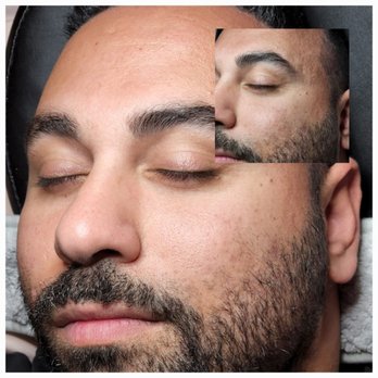 Wellnes Skincare - Fresh-Nes Facial Before and After - Skin Care Near Me - Campbell, California Wellnes Skincare - Fresh-Nes Facial Before and After - Skin Care Near Me - Campbell, California