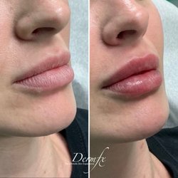 DermFx