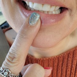 Clay C Michels, DDS - Sunnylane Family Dentistry - 1/3 of veneer is transparent