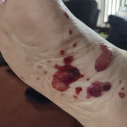 Clark Fork Valley Hospital & Family Medicine Network - Just a few pics of what he went through, these were kind of minor to what he had all over his body
