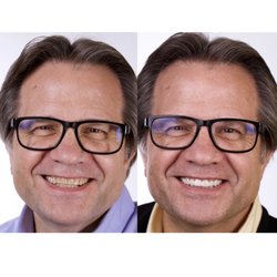 Davis Dental - Smile Makeover with porcelain crowns and digital smile design