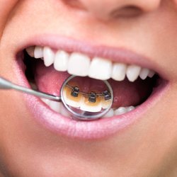Escott Orthodontics - Orthodontic treatment with lingual hidden braces