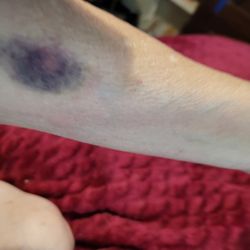 Gonzaba Medical Group - Women taking blood samples hurt me.