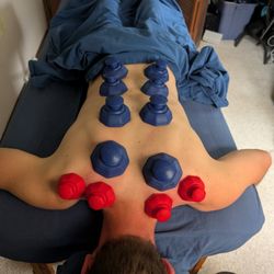 Steven Pagel Massage Therapy - Cupping. Best ever!