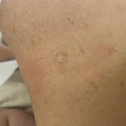 Seaver Soon MD - The Skin Clinic MD - Post Biopsy