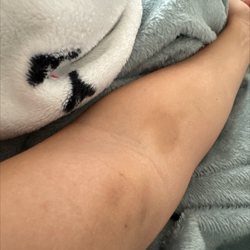 Labcorp - Blood exams 1 week ago, still bruised up, DO NOT GET ANY EXAM THERE!!!