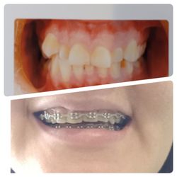 Alina Oganyan, DDS - Oganyan Dentistry - The before on the top and after. (These are not the final results.)