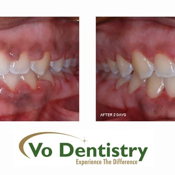 Vo Dentistry - Gum surgery with minimal discomfort - General Dentistry Near Me - Lawrenceville, Georgia Vo Dentistry - Gum surgery with minimal discomfort - General Dentistry Near Me - Lawrenceville, Georgia
