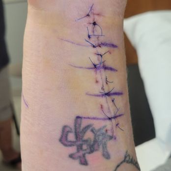 Franciscan Physician Network Orthopedic Specialists - Again second surgery getting stitches removed - Orthopedists Near Me - Indianapolis, Indiana Franciscan Physician Network Orthopedic Specialists - Again second surgery getting stitches removed - Orthopedists Near Me - Indianapolis, Indiana