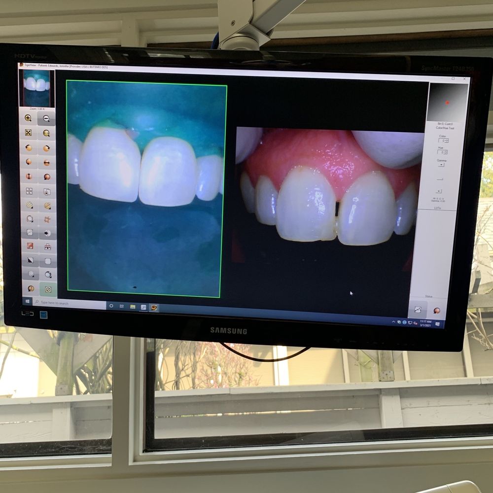 Fife Dental Center - The right is before the filling and the left is after. What a difference!!! - General Dentistry Near Me - Tacoma, Washington Fife Dental Center - The right is before the filling and the left is after. What a difference!!! - General Dentistry Near Me - Tacoma, Washington