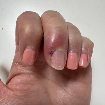 Charisma Salon - Swollen infected finger, had to be cut open and drained at urgent care after manicure - Hair Salons Near Me - Menlo Park, California