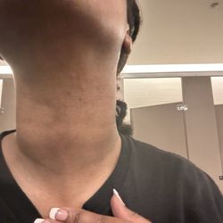 Nails Luxury - Neck breakout after wax