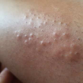 Laserium MedSpa - Same machine ,same location on  Opposing leg, Different reaction,... Something to be said about experienced using machine - Skin Care Near Me - Prescott, Arizona