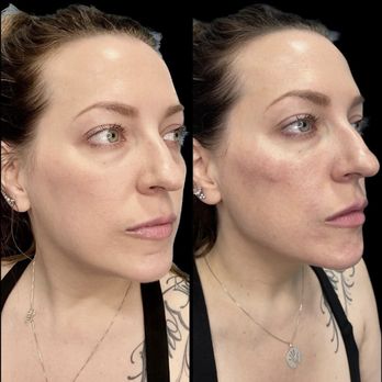 ZO Skin Centre - Dermal filler, Botox, and PRF Injection transformation at ZO Skin Centre Dallas. - Skin Care Near Me - Dallas, Texas