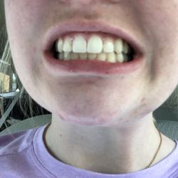 West Orthodontics - Finished result after braces: horrible