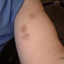 South County Mental Health Center - Finger bruises confirmed by hospital doctor. I've had this bruise for 5 days