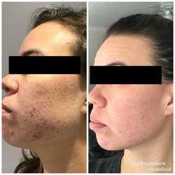 LaRaydiance Wellness Spa Boutique - Before after