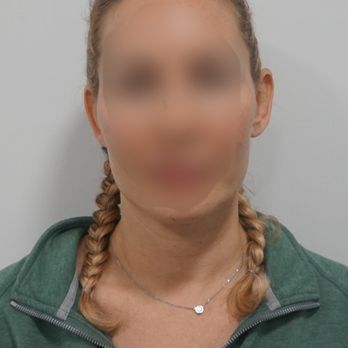 Misbah Khan, MD - Before - Dermatologists Near Me - New York, New York Misbah Khan, MD - Before - Dermatologists Near Me - New York, New York