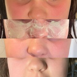 Dermalessence - Progress of topical products calming a sunburn. First photo is immediately after the burn and the last photo is the very next day.