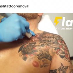Flash Tattoo Removal