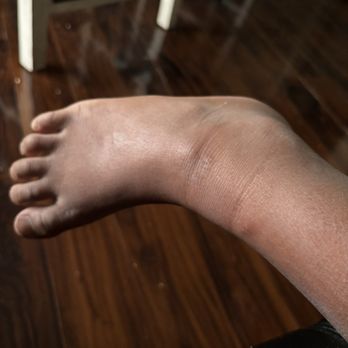 Vacasa - My sons ankle with a bed bug bite - Vacation Rentals Near Me Vacasa - My sons ankle with a bed bug bite - Vacation Rentals Near Me