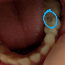 Centro Dental Alfaz del PI - The sealing done by Dr. Gert Schilderoth split open again shortly afterwards.