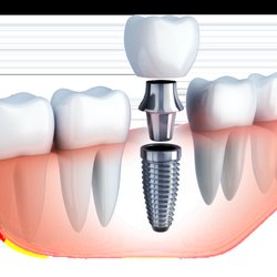 Ridgefield Dental Arts - Dr. Bilius has advanced training and years of experience in dental implants to help ensure a great experience at Ridgefield Dental Arts.