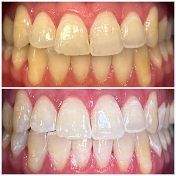 Deebeaut - First treatment - Teeth Whitening Near Me Deebeaut - First treatment - Teeth Whitening Near Me